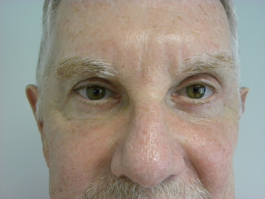 Male Blepharoplasty Before and After Pictures Miami, FL