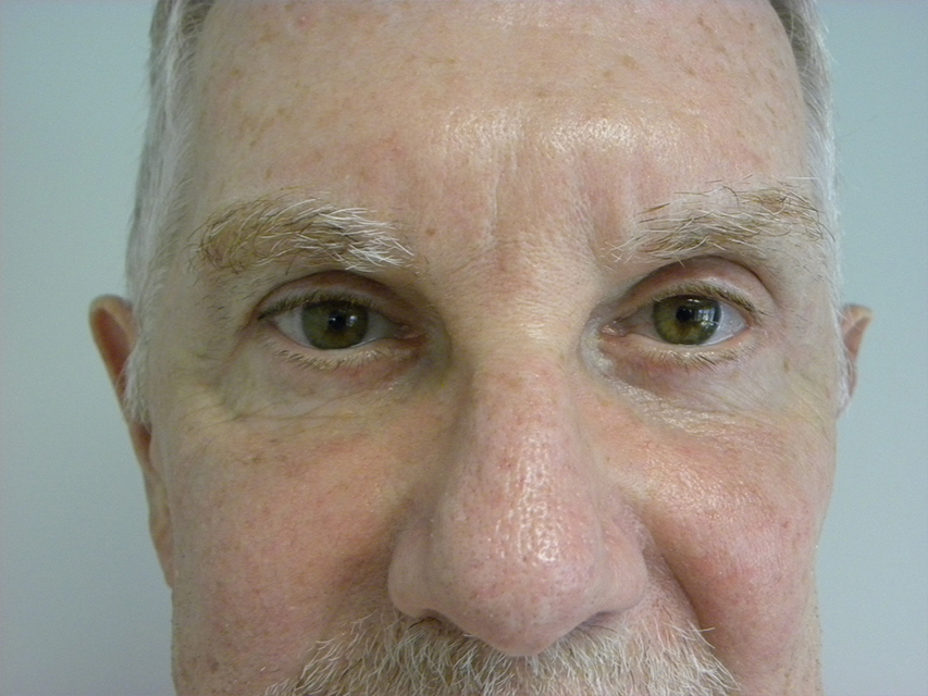 Blepharoplasty Before and After Pictures in Miami, FL