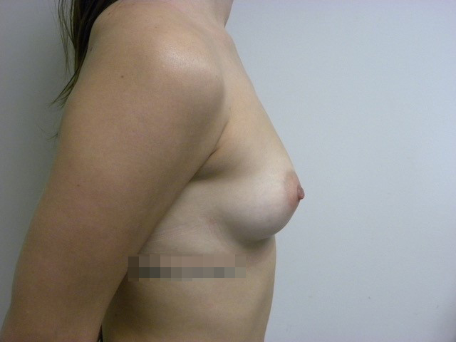 Breast Augmentation Before and After Pictures in Miami, FL