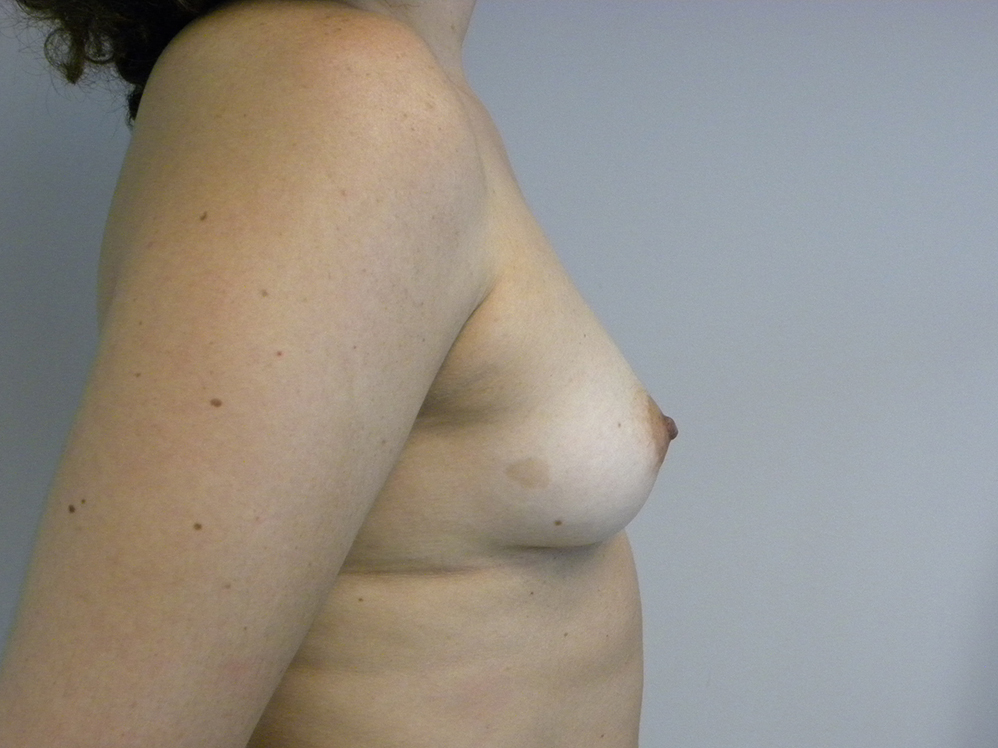 Breast Augmentation Before and After Pictures Miami, FL