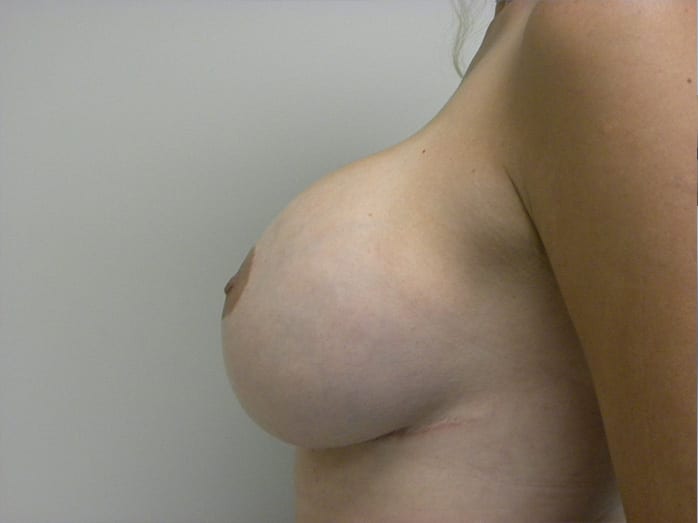 Breast Revision Before and After Pictures Miami, FL