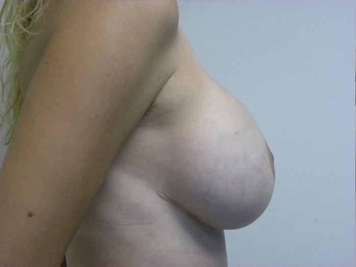 Breast Revision Before and After Pictures Miami, FL