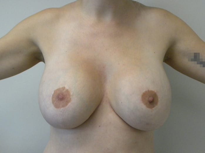 Breast Revision Before and After Pictures Miami, FL