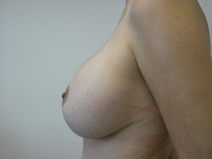 Breast Revision Before and After Pictures Miami, FL