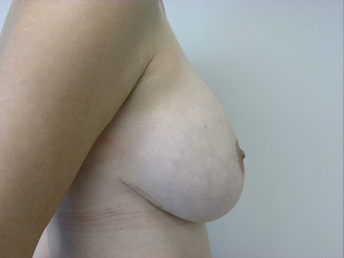 Breast Revision Before and After Pictures Miami, FL