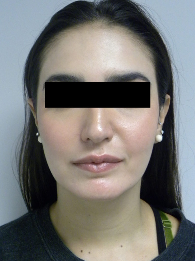 CHIN IMPLANT BEFORE AND AFTER PICTURES MIAMI, FL