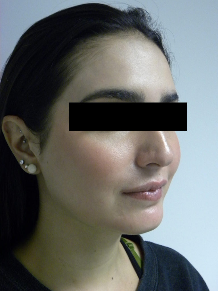 CHIN IMPLANT BEFORE AND AFTER PICTURES MIAMI, FL