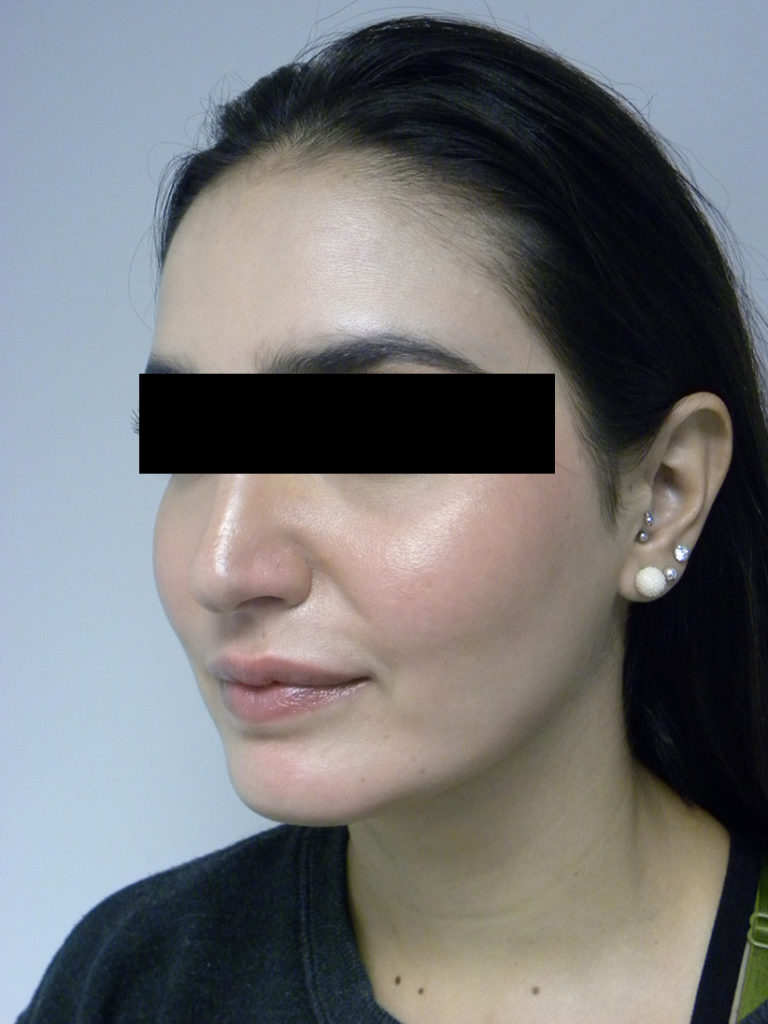 CHIN IMPLANT BEFORE AND AFTER PICTURES MIAMI, FL