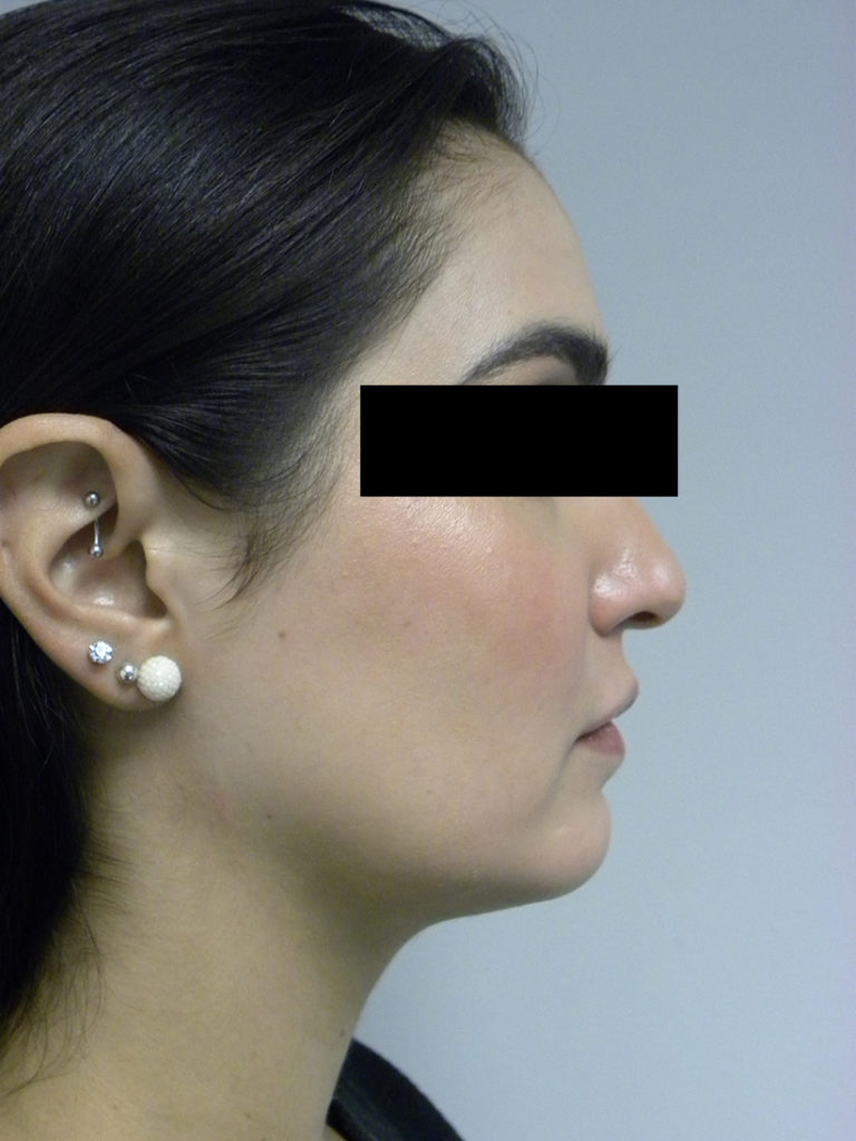 CHIN IMPLANT BEFORE AND AFTER PICTURES MIAMI, FL