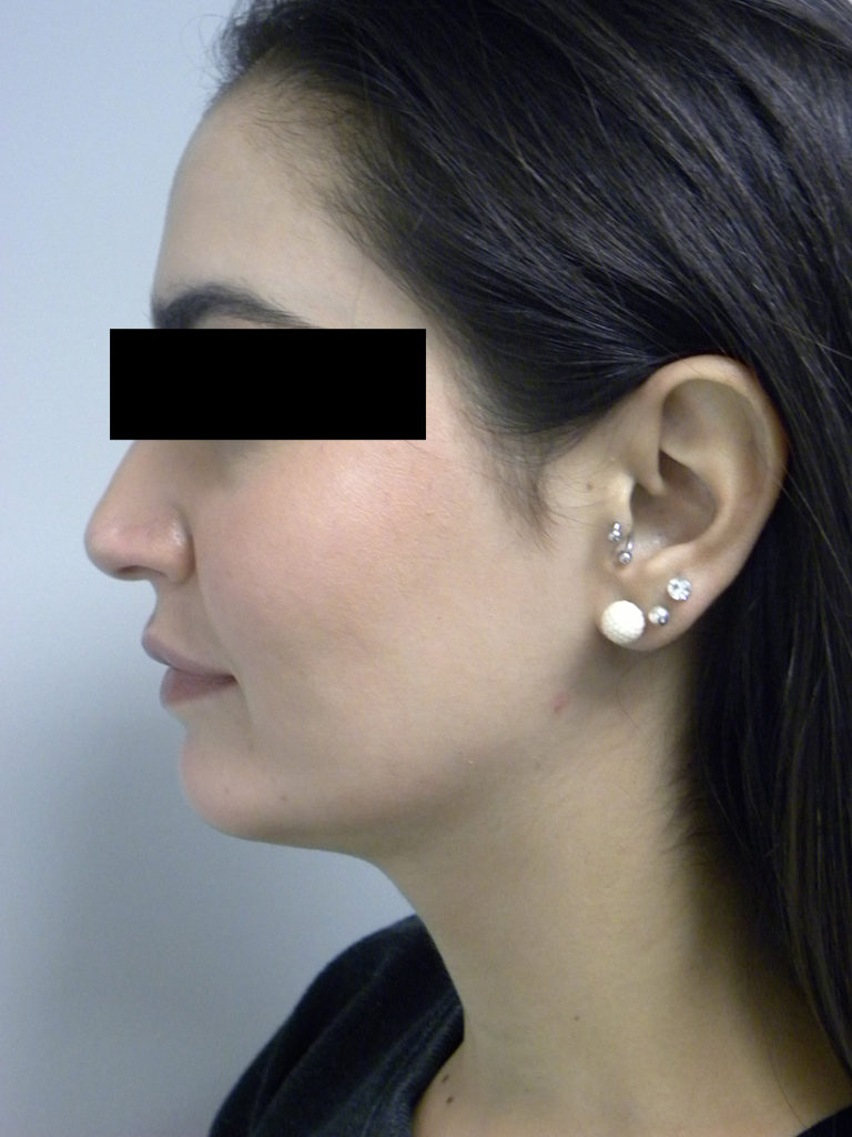 CHIN IMPLANT BEFORE AND AFTER PICTURES MIAMI, FL