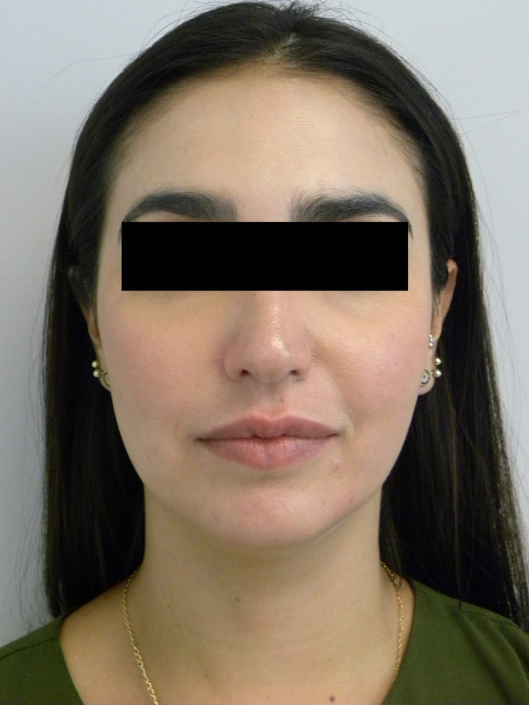 CHIN IMPLANT BEFORE AND AFTER PICTURES MIAMI, FL