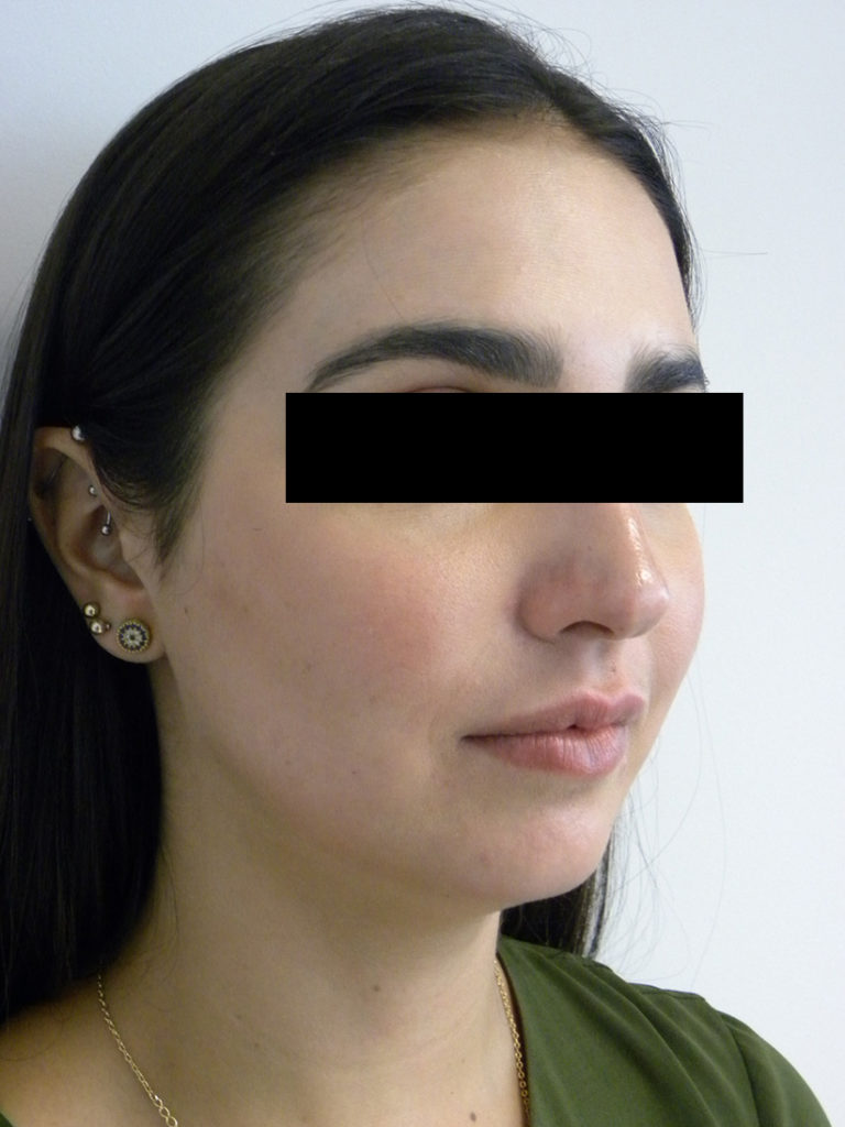 CHIN IMPLANT BEFORE AND AFTER PICTURES MIAMI, FL