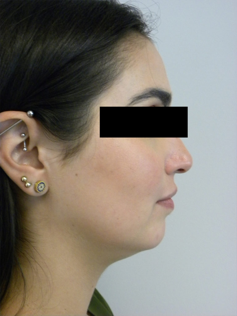 CHIN IMPLANT BEFORE AND AFTER PICTURES MIAMI, FL