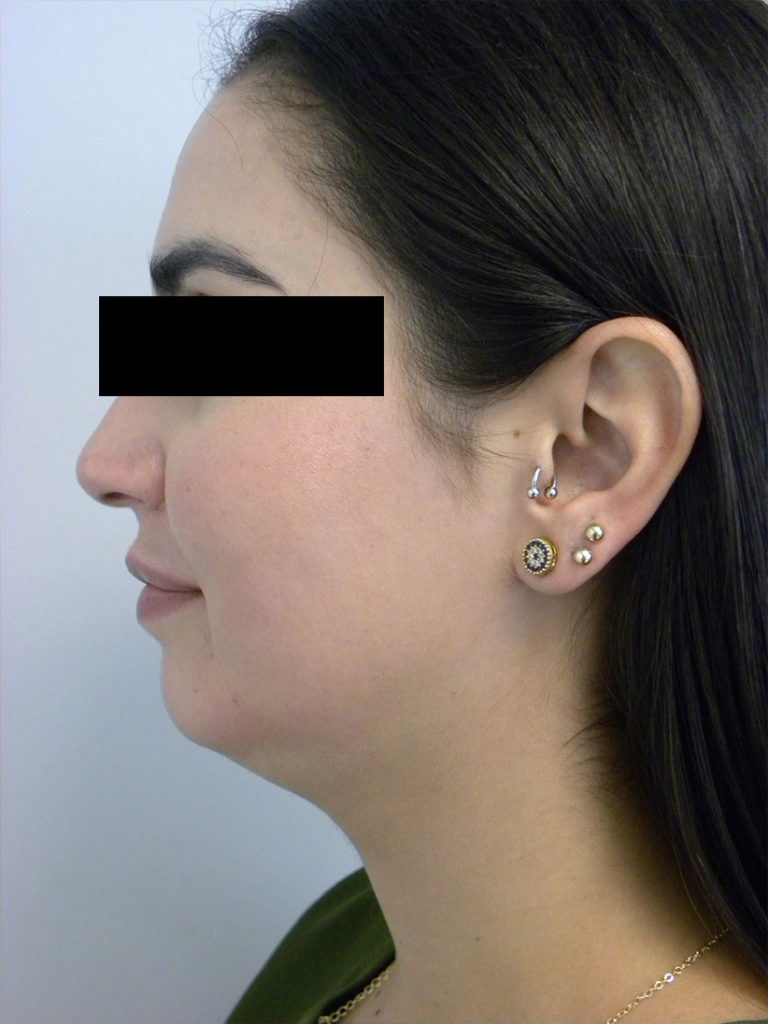 CHIN IMPLANT BEFORE AND AFTER PICTURES MIAMI, FL