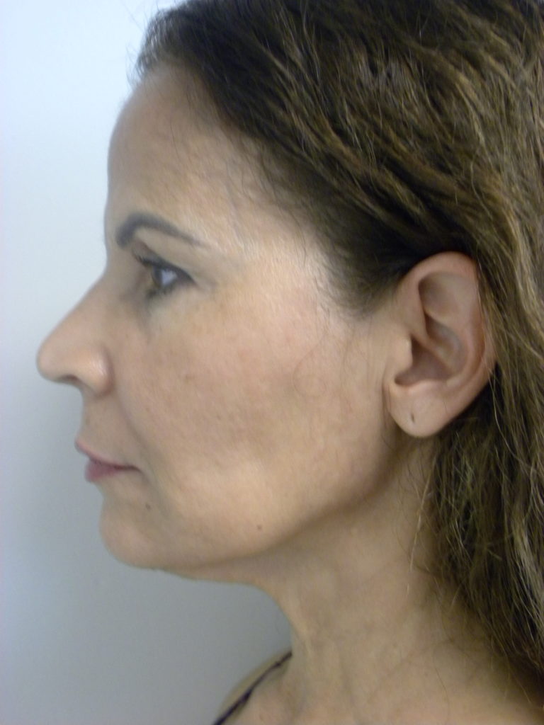 Neck Lift Before and After Pictures Miami, FL