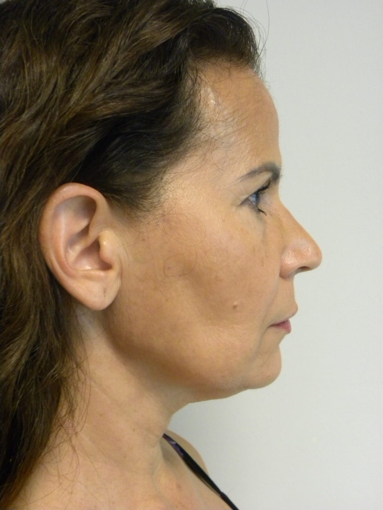 Neck Lift Before and After Pictures Miami, FL