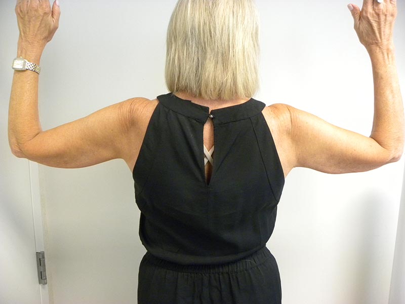 Arm Lift Before and After Pictures Miami, Aventura, FL