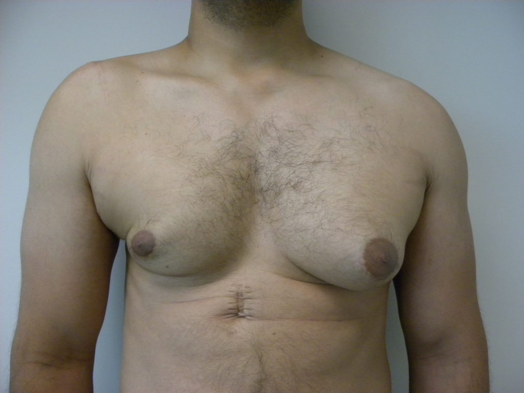 Gynecomastia Before and After Pictures Miami, FL