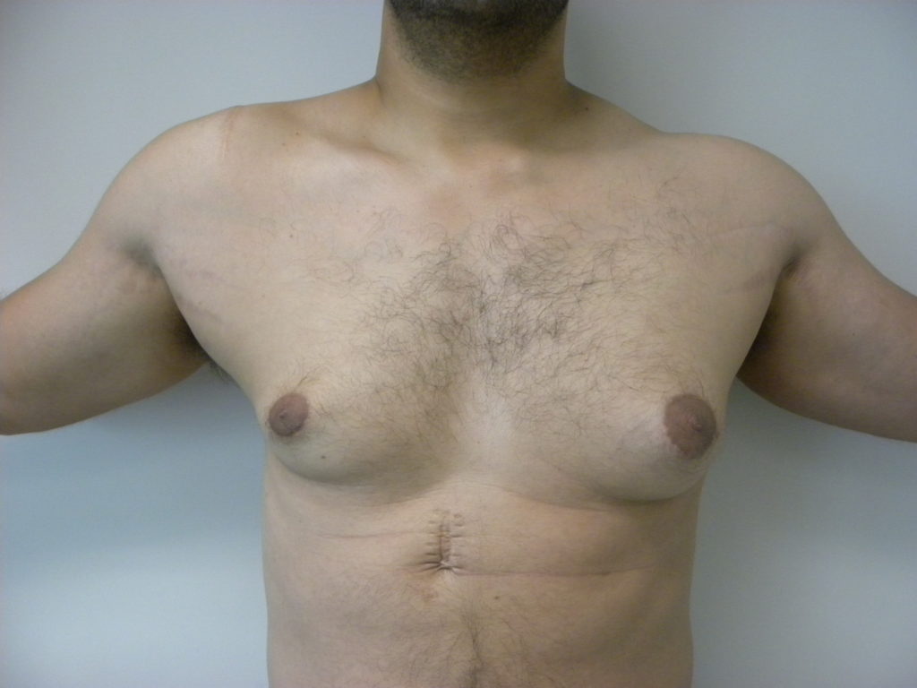 Gynecomastia Before and After Pictures Miami, FL