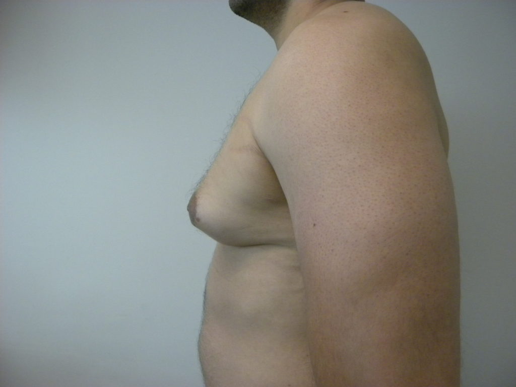 Gynecomastia Before and After Pictures Miami, FL