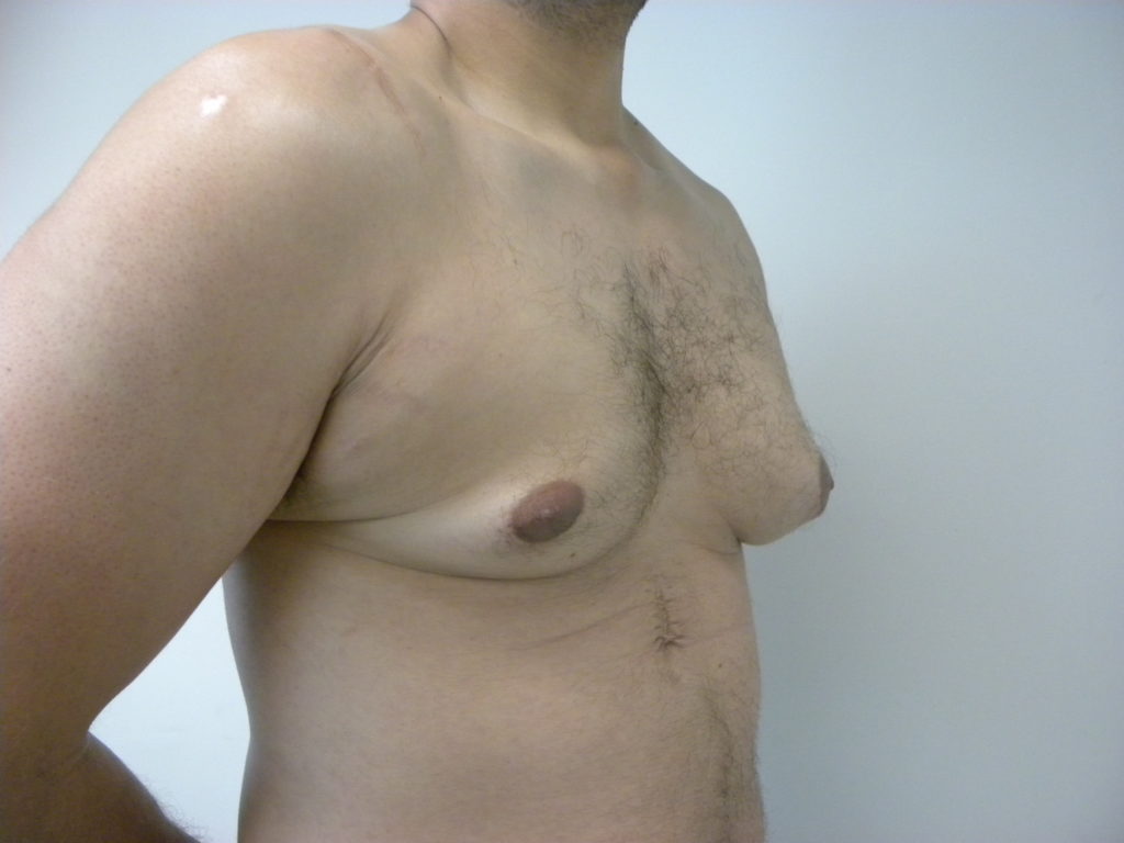 Gynecomastia Before and After Pictures Miami, FL