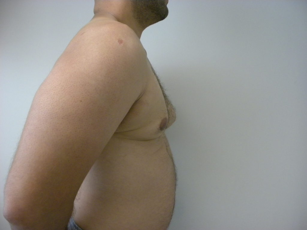 Gynecomastia Before and After Pictures Miami, FL