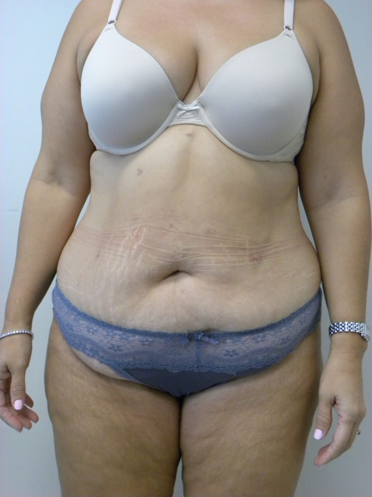 Tummy Tuck Before and After Pictures Miami, FL