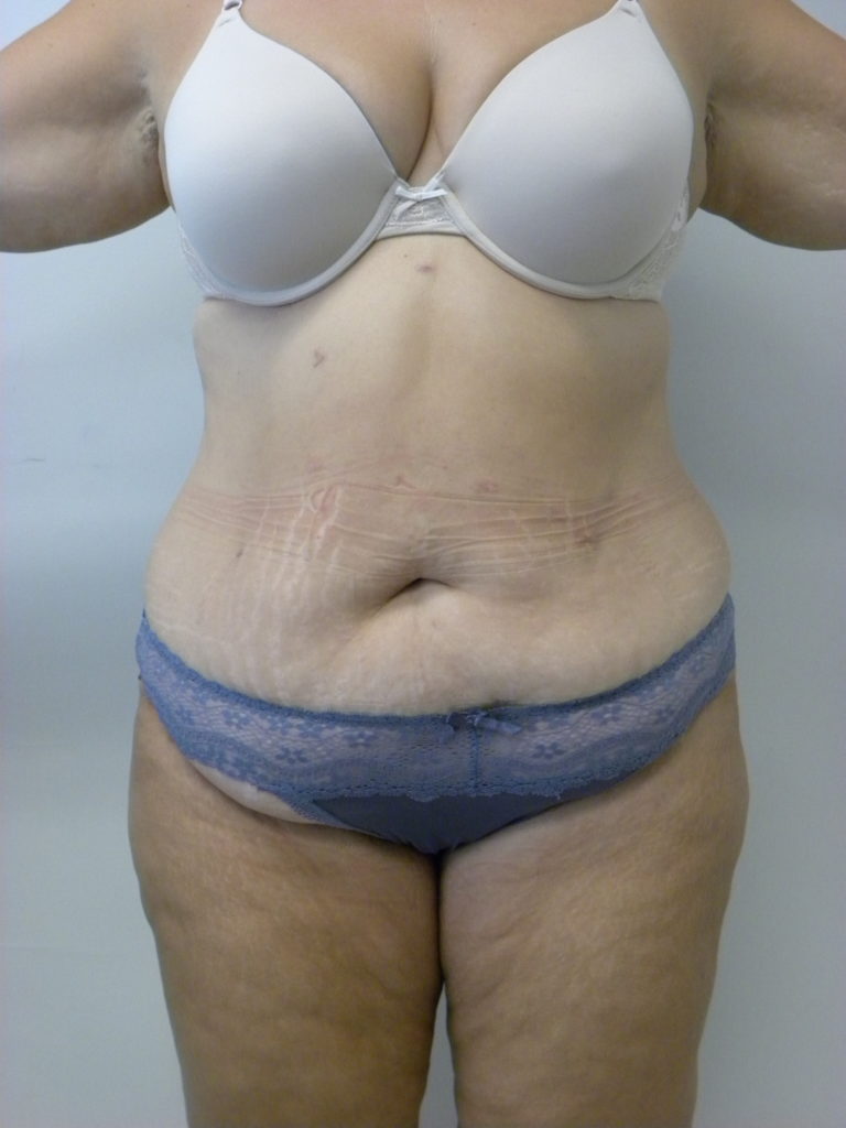 Tummy Tuck Before and After Pictures Miami, FL