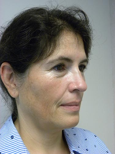 Neck Lift Before and After Pictures Miami, FL