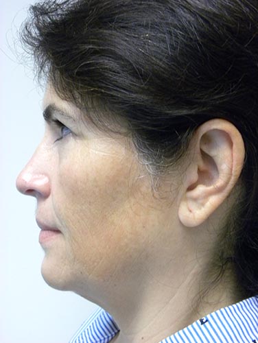 Minimally Invasive Neck Lift with Ellevate Before and After Pictures Miami, FL