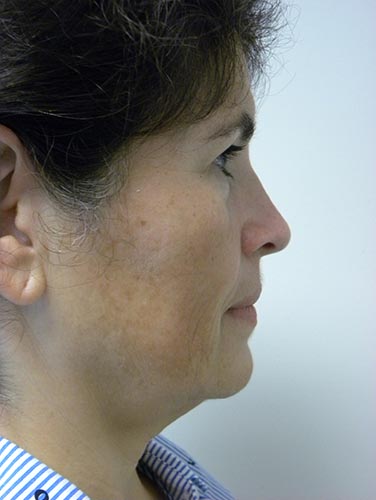 Minimally Invasive Neck Lift with Ellevate Before and After Pictures Miami, FL