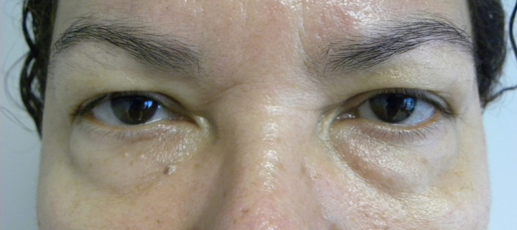 Blepharoplasty Before and After Pictures in Miami, FL