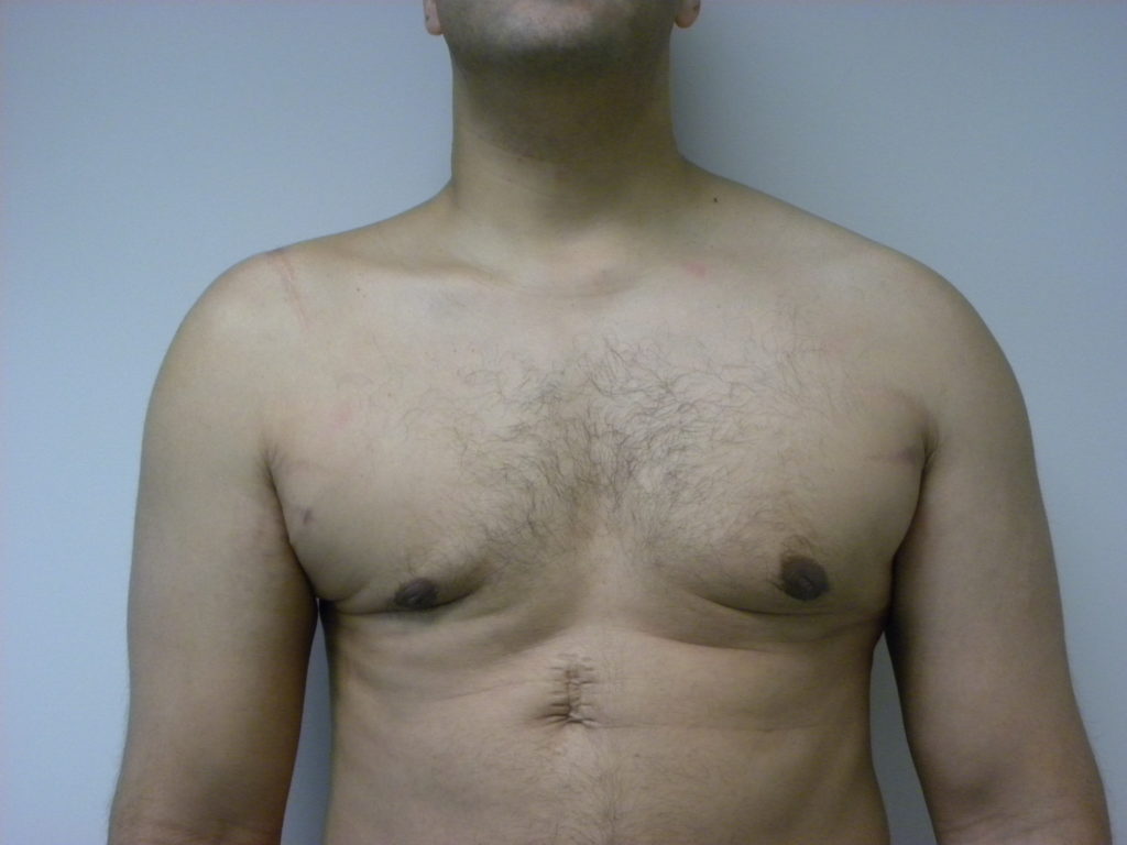 Gynecomastia Before and After Pictures Miami, FL