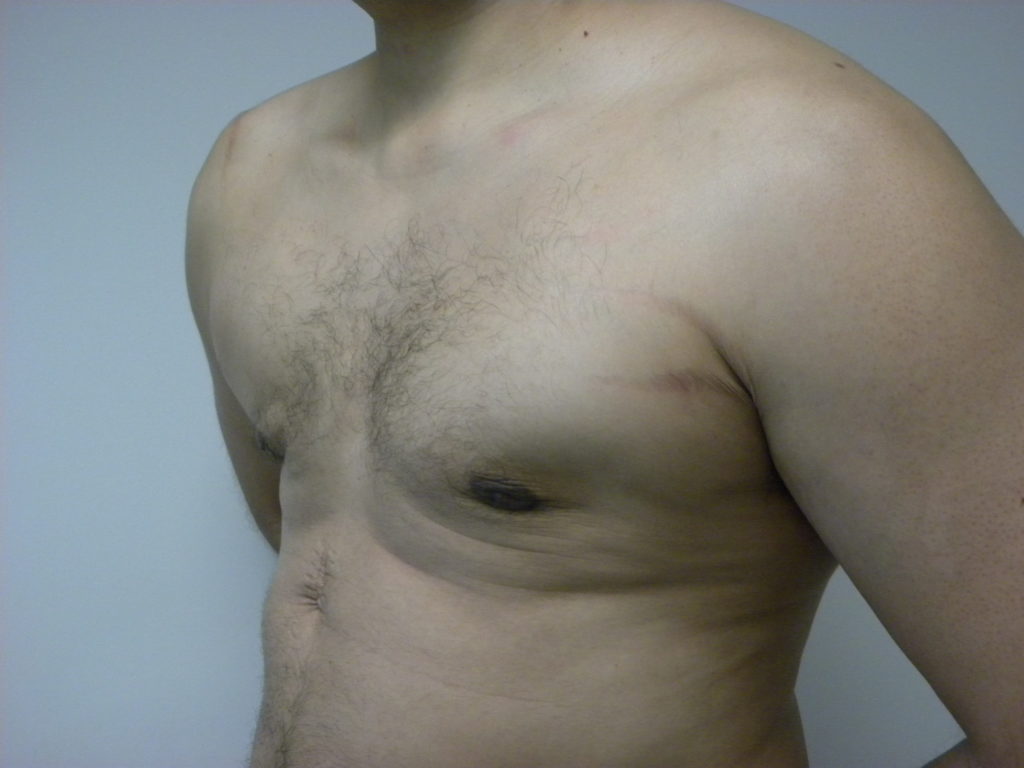 Gynecomastia Before and After Pictures Miami, FL