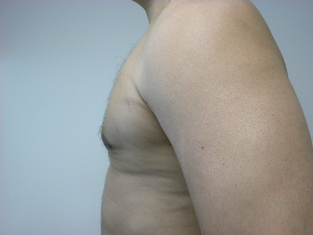 Gynecomastia Before and After Pictures Miami, FL