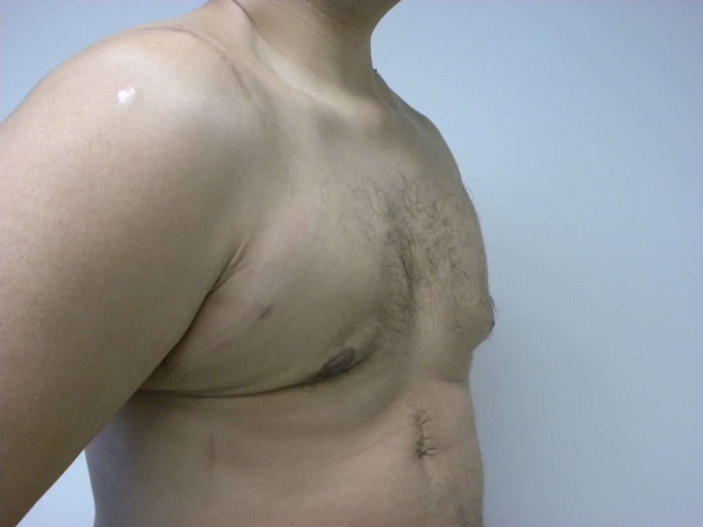 Gynecomastia Before and After Pictures Miami, FL