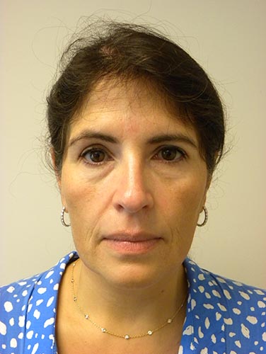 Neck Lift Before and After Pictures Miami, FL