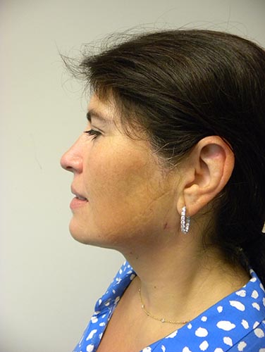 Minimally Invasive Neck Lift with Ellevate Before and After Pictures Miami, FL