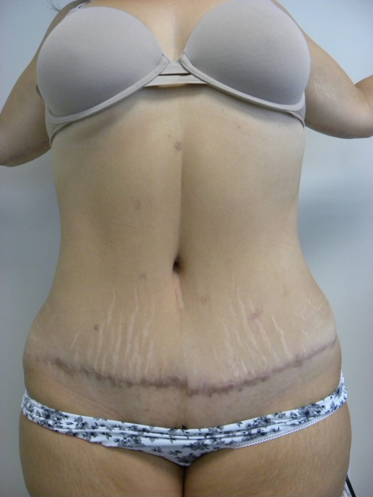 Tummy Tuck Before and After Pictures Miami, FL