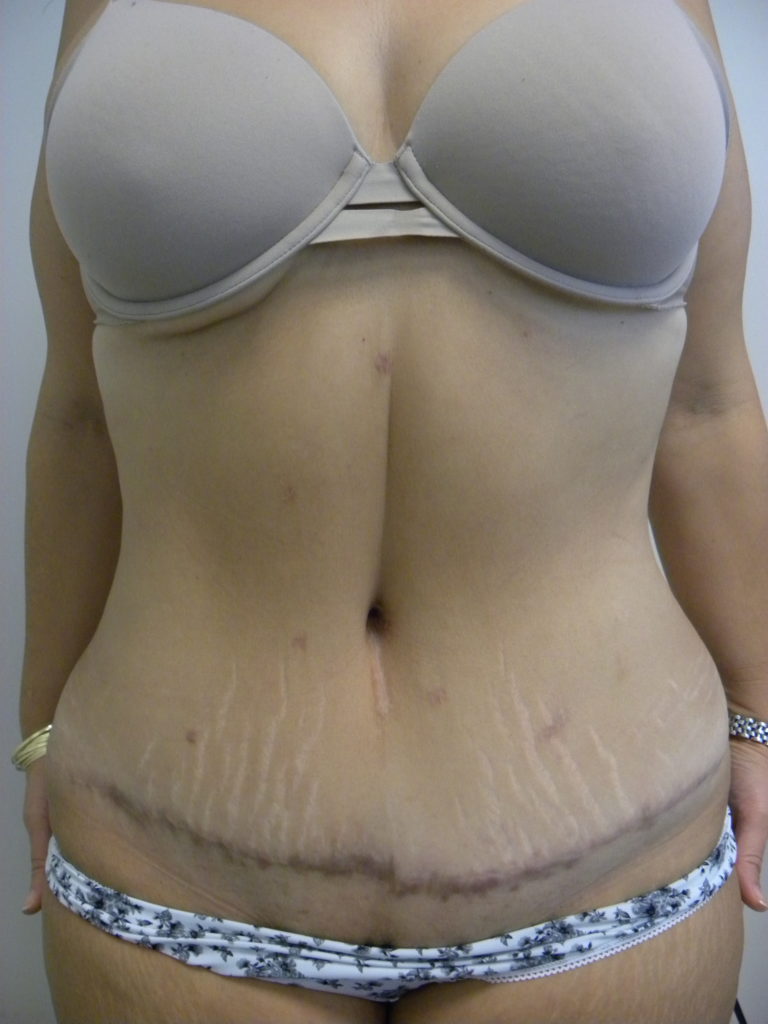 Tummy Tuck Before and After Pictures Miami, FL