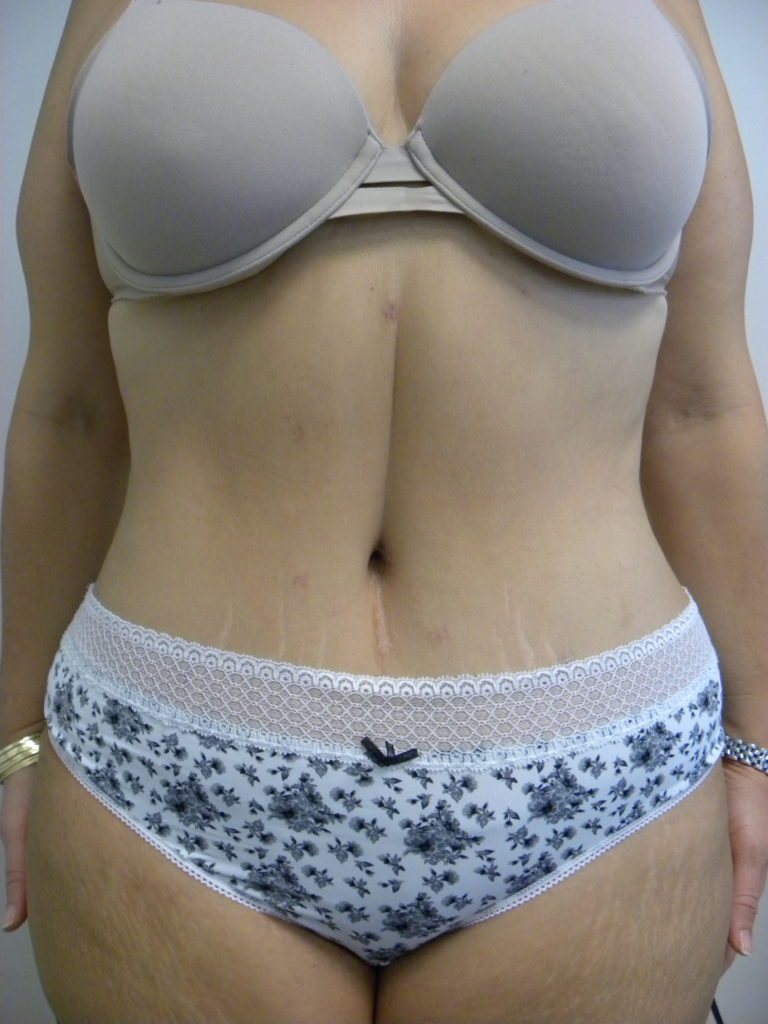 Tummy Tuck Before and After Pictures Miami, FL