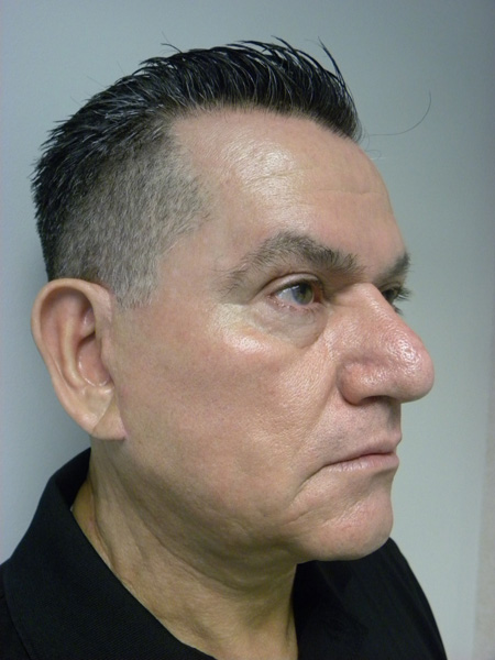 Male Facelift Before and After Pictures Miami, FL