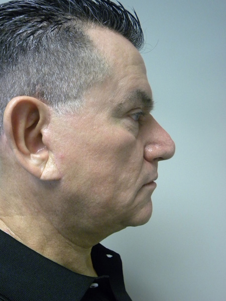 Male Facelift Before and After Pictures Miami, FL