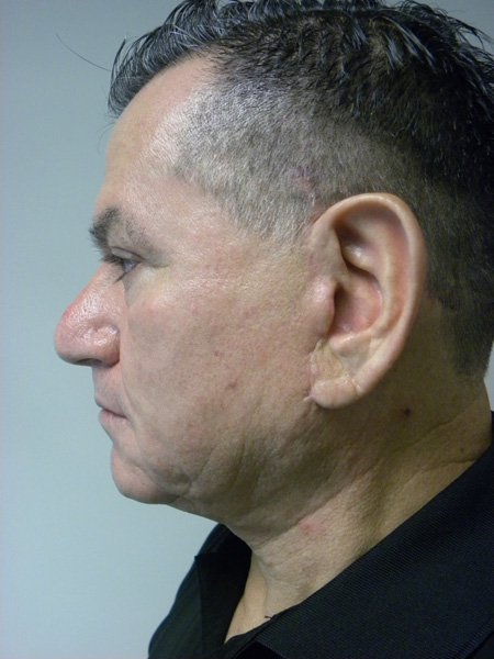 Male Facelift Before and After Pictures Miami, FL