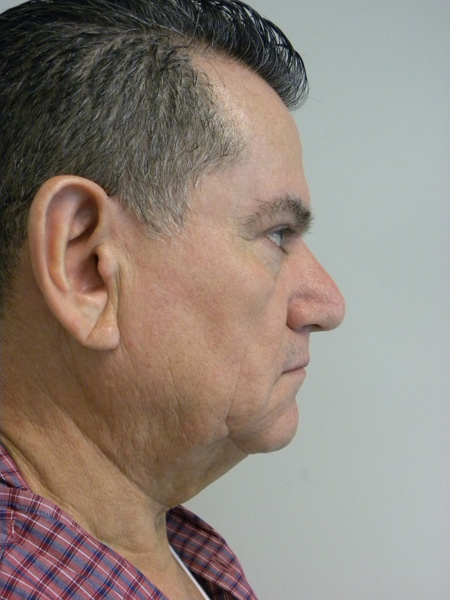 Male Facelift Before and After Pictures Miami, FL