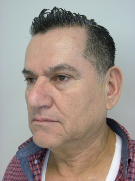 Male Facelift Before and After Pictures Miami, FL