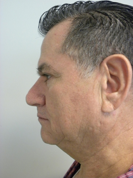 Male Facelift Before and After Pictures Miami, FL