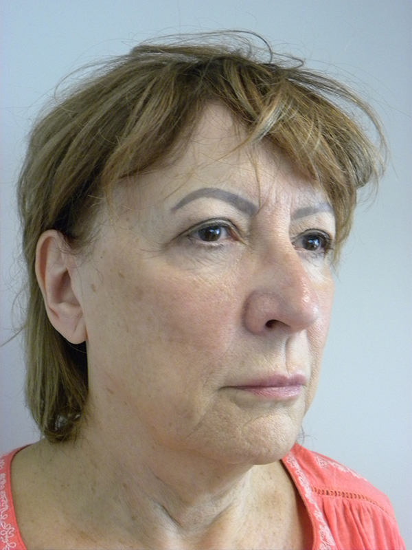 FACELIFT BEFORE AND AFTER PICTURES IN MIAMI, FL