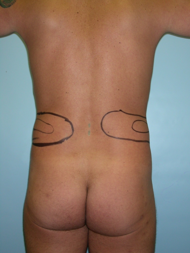 Male Liposuction Before and After Pictures Miami, FL