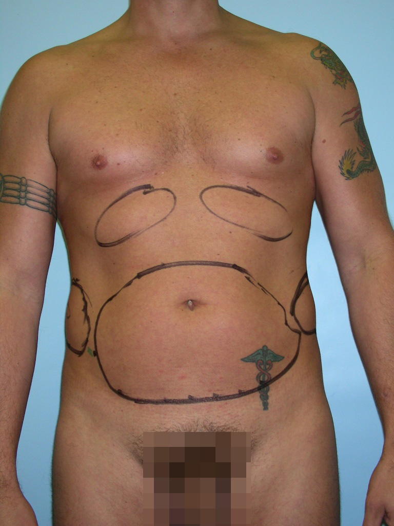 Male Liposuction Before and After Pictures Miami, FL